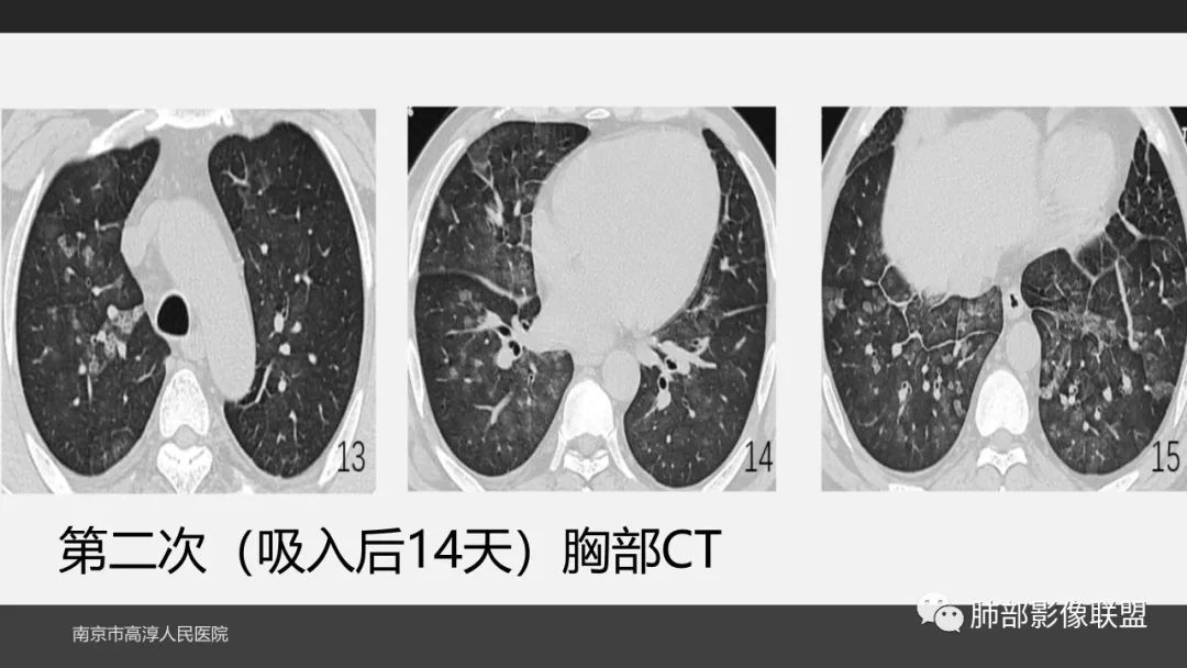 影像PPT - 【PPT】84消毒剂所致吸入性肺损伤的影像表现及其动态转归-14
