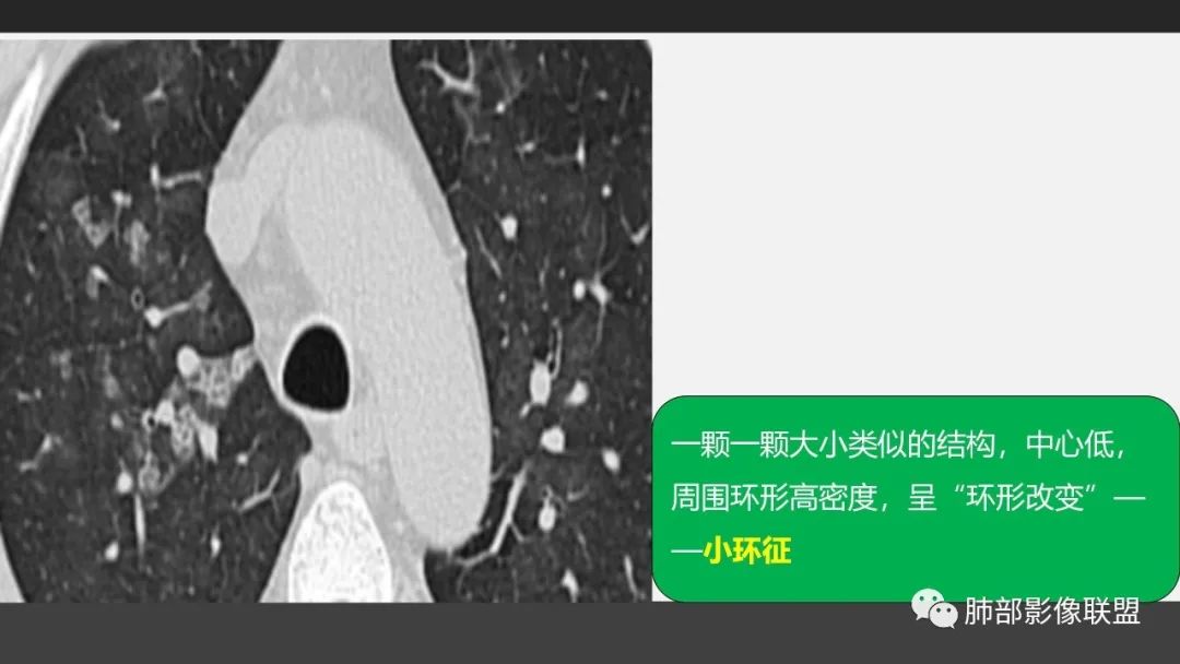 影像PPT - 【PPT】84消毒剂所致吸入性肺损伤的影像表现及其动态转归-15