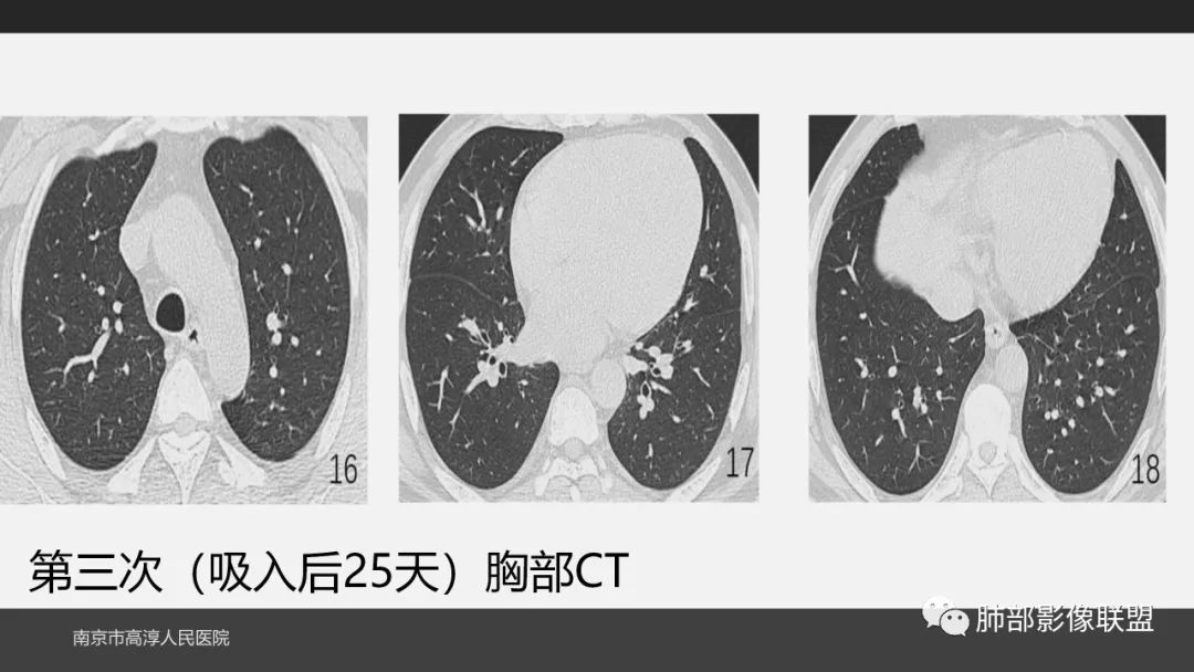 影像PPT - 【PPT】84消毒剂所致吸入性肺损伤的影像表现及其动态转归-16