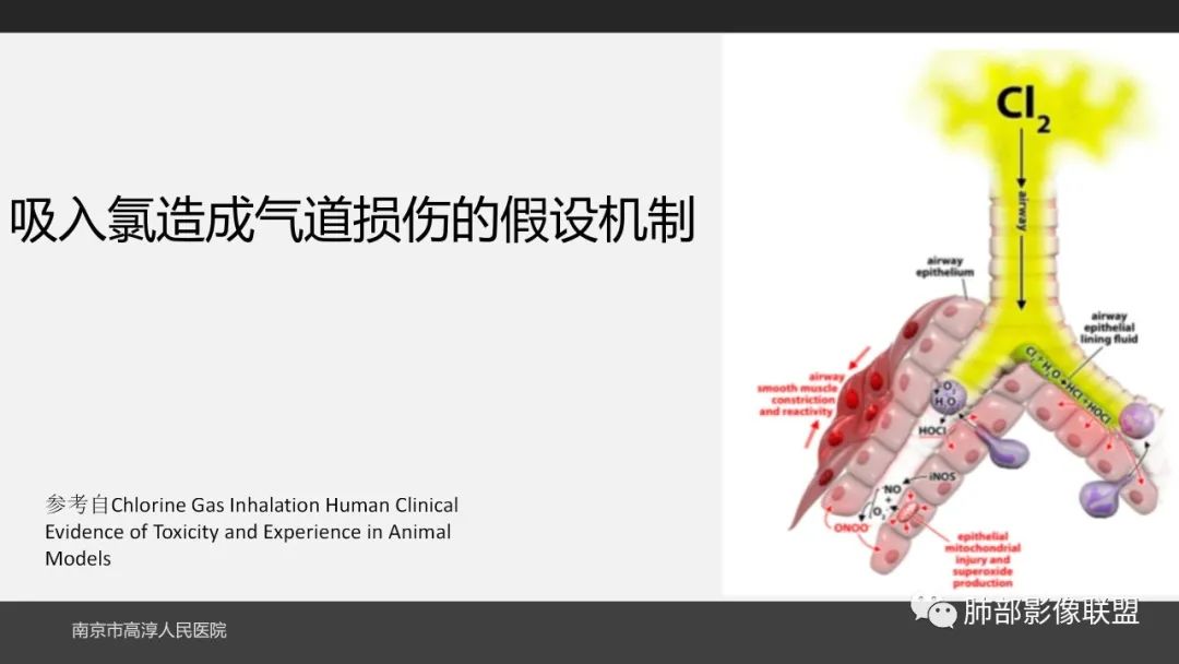 影像PPT - 【PPT】84消毒剂所致吸入性肺损伤的影像表现及其动态转归-22