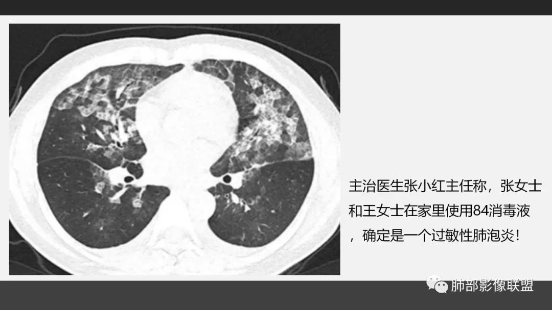 影像PPT - 【PPT】84消毒剂所致吸入性肺损伤的影像表现及其动态转归-31
