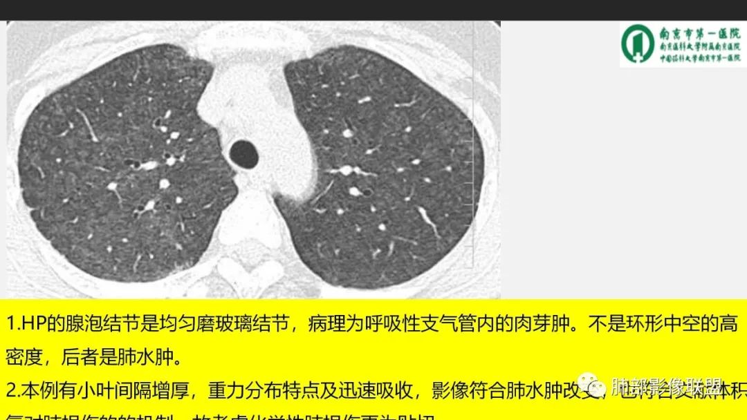 影像PPT - 【PPT】84消毒剂所致吸入性肺损伤的影像表现及其动态转归-33