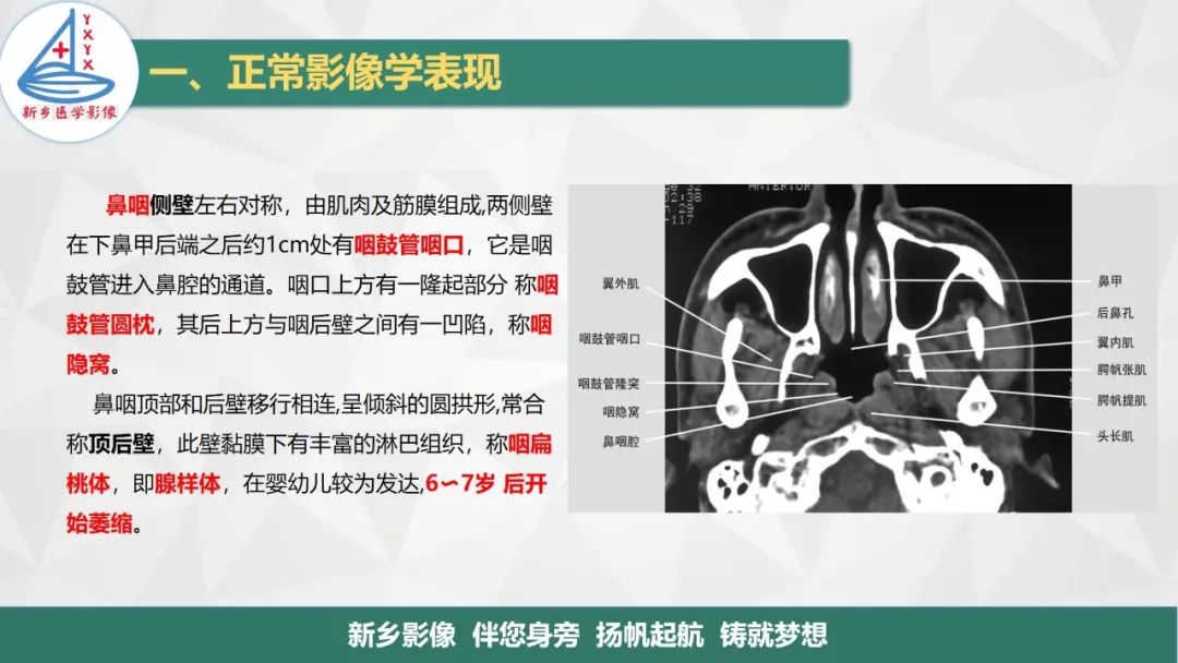 影像PPT - 【PPT】医学影像诊断学教材解读—咽部疾病-4