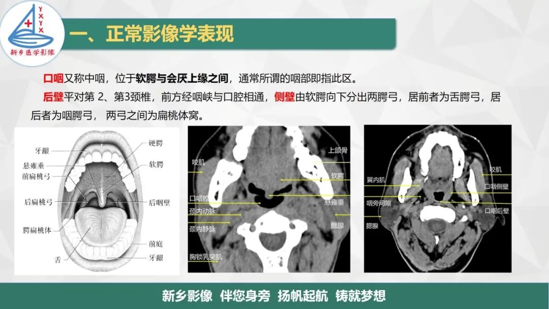 影像PPT - 【PPT】医学影像诊断学教材解读—咽部疾病-5