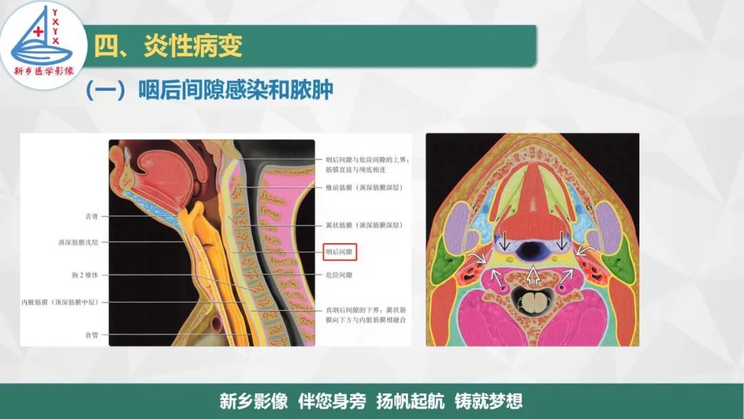 影像PPT - 【PPT】医学影像诊断学教材解读—咽部疾病-12