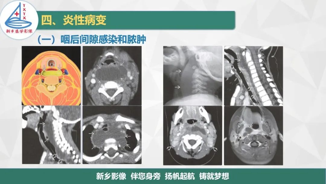 影像PPT - 【PPT】医学影像诊断学教材解读—咽部疾病-15