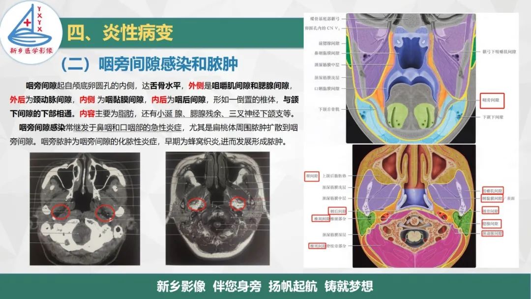 影像PPT - 【PPT】医学影像诊断学教材解读—咽部疾病-17