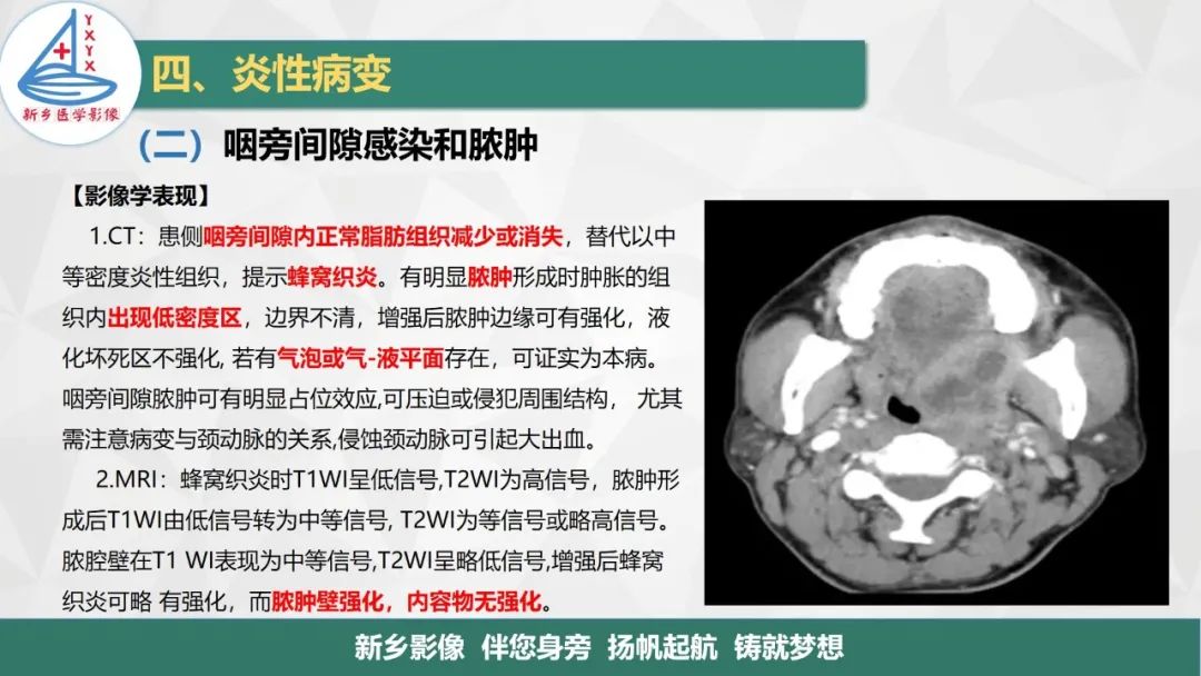 影像PPT - 【PPT】医学影像诊断学教材解读—咽部疾病-18