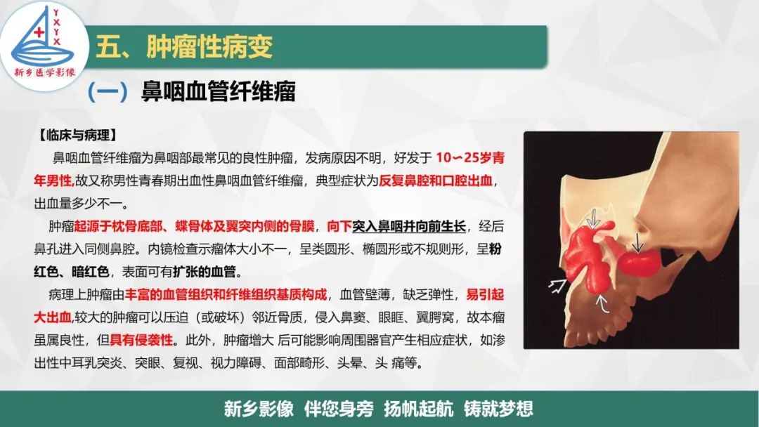 影像PPT - 【PPT】医学影像诊断学教材解读—咽部疾病-20