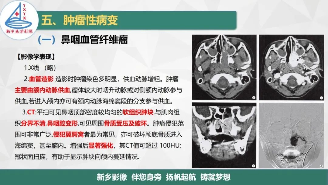 影像PPT - 【PPT】医学影像诊断学教材解读—咽部疾病-21