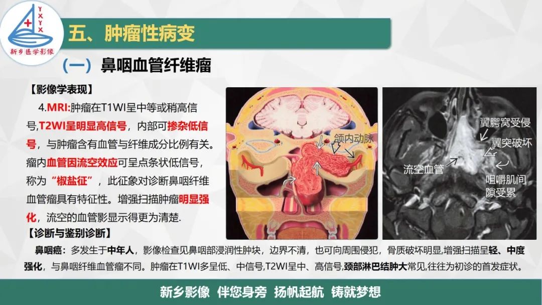 影像PPT - 【PPT】医学影像诊断学教材解读—咽部疾病-22