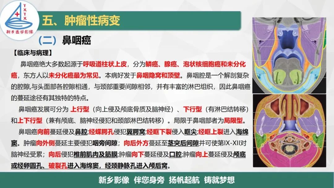 影像PPT - 【PPT】医学影像诊断学教材解读—咽部疾病-24