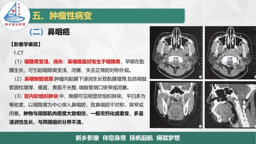 影像PPT - 【PPT】医学影像诊断学教材解读—咽部疾病-25