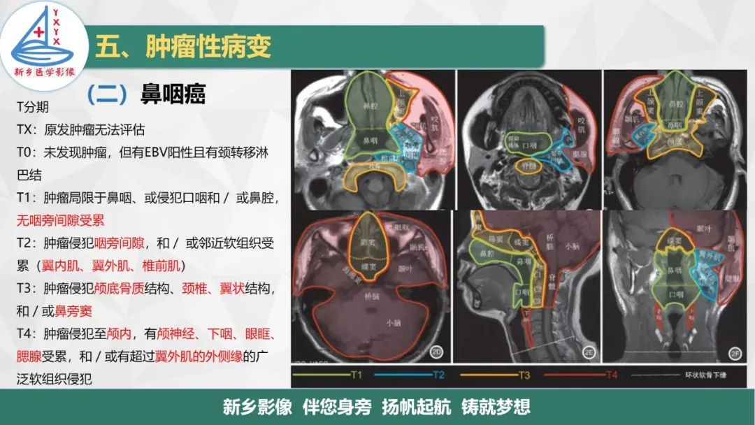 影像PPT - 【PPT】医学影像诊断学教材解读—咽部疾病-28