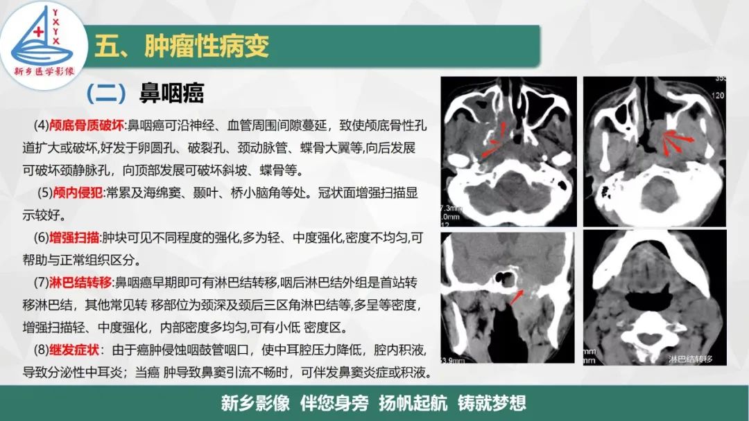 影像PPT - 【PPT】医学影像诊断学教材解读—咽部疾病-26