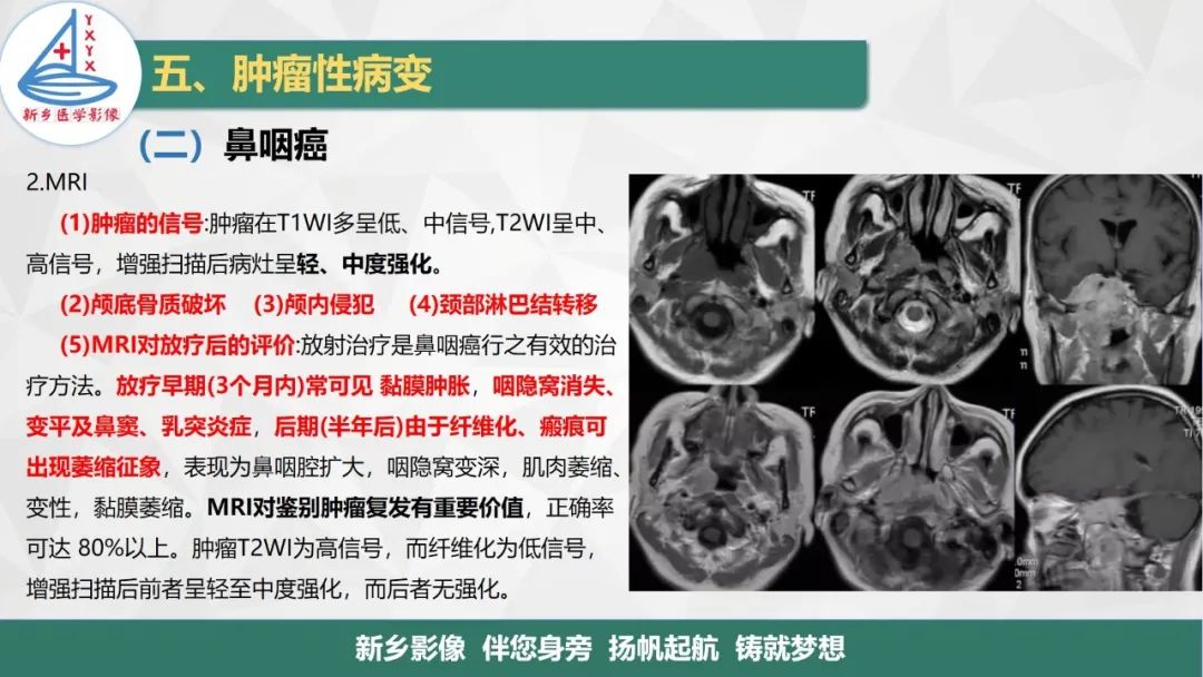 影像PPT - 【PPT】医学影像诊断学教材解读—咽部疾病-27