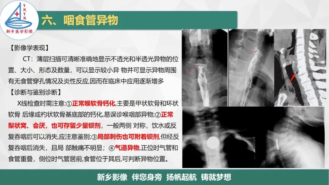 影像PPT - 【PPT】医学影像诊断学教材解读—咽部疾病-31
