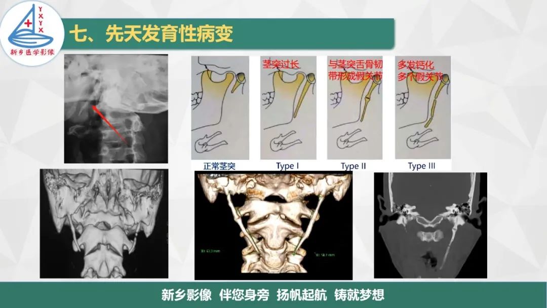 影像PPT - 【PPT】医学影像诊断学教材解读—咽部疾病-34