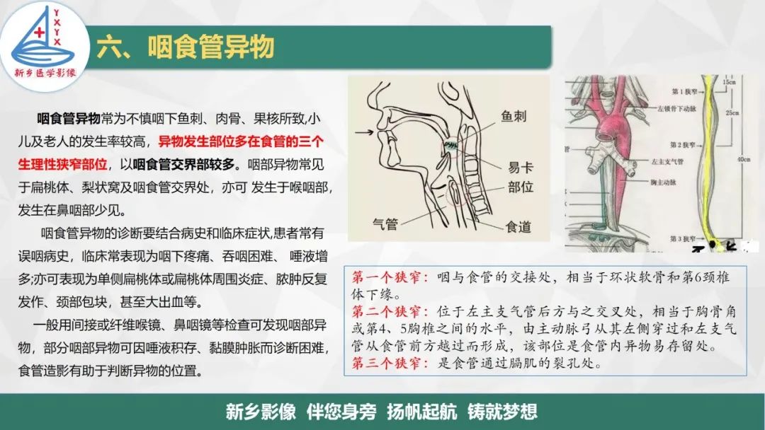 影像PPT - 【PPT】医学影像诊断学教材解读—咽部疾病-30