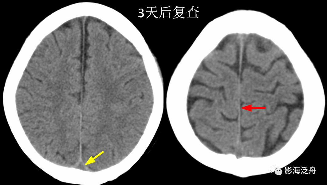影像PPT - 大脑镰旁急性硬膜下血肿与蛛网膜下腔出血的鉴别-5 影像PPT - 大脑镰旁急性硬膜下血肿与蛛网膜下腔出血的鉴别-5