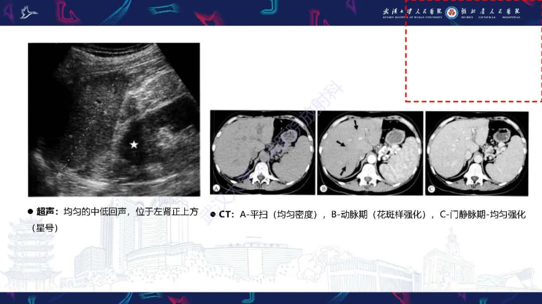 影像PPT - 【PPT】先天性脾脏异常影像诊断-8