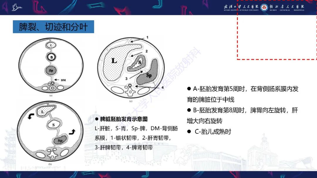 影像PPT - 【PPT】先天性脾脏异常影像诊断-11