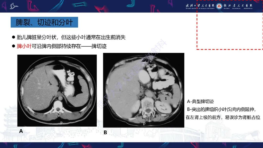 影像PPT - 【PPT】先天性脾脏异常影像诊断-12
