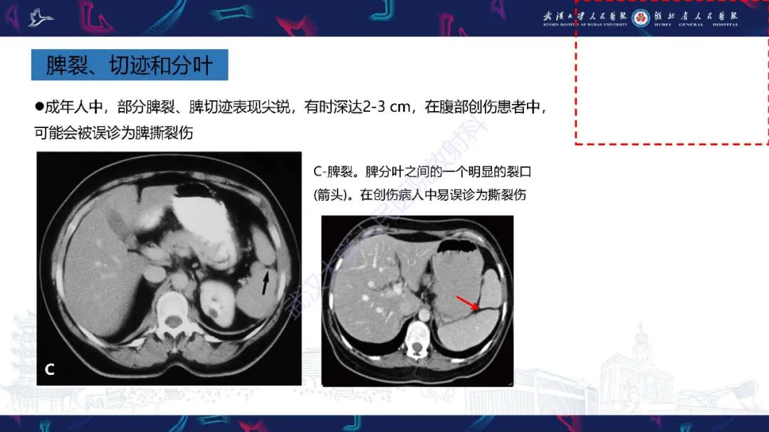 影像PPT - 【PPT】先天性脾脏异常影像诊断-14