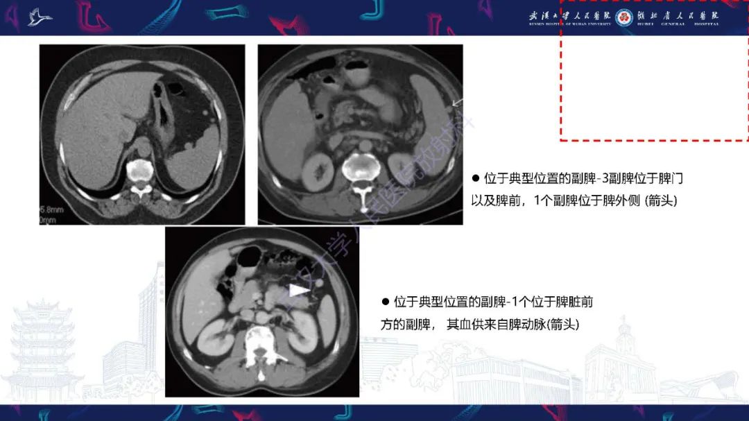 影像PPT - 【PPT】先天性脾脏异常影像诊断-16