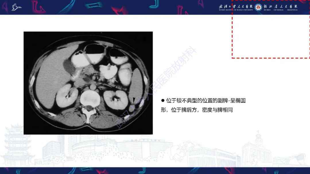 影像PPT - 【PPT】先天性脾脏异常影像诊断-17