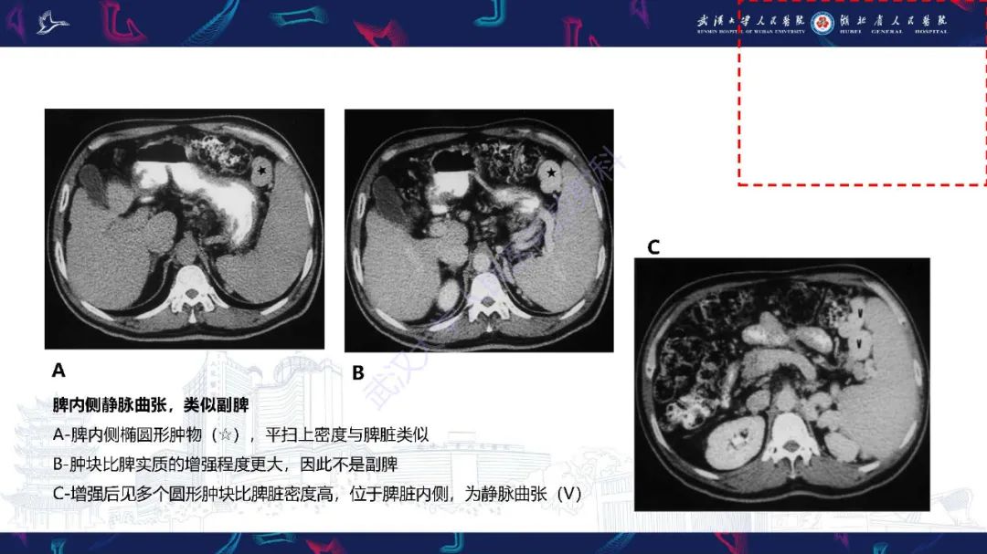 影像PPT - 【PPT】先天性脾脏异常影像诊断-19