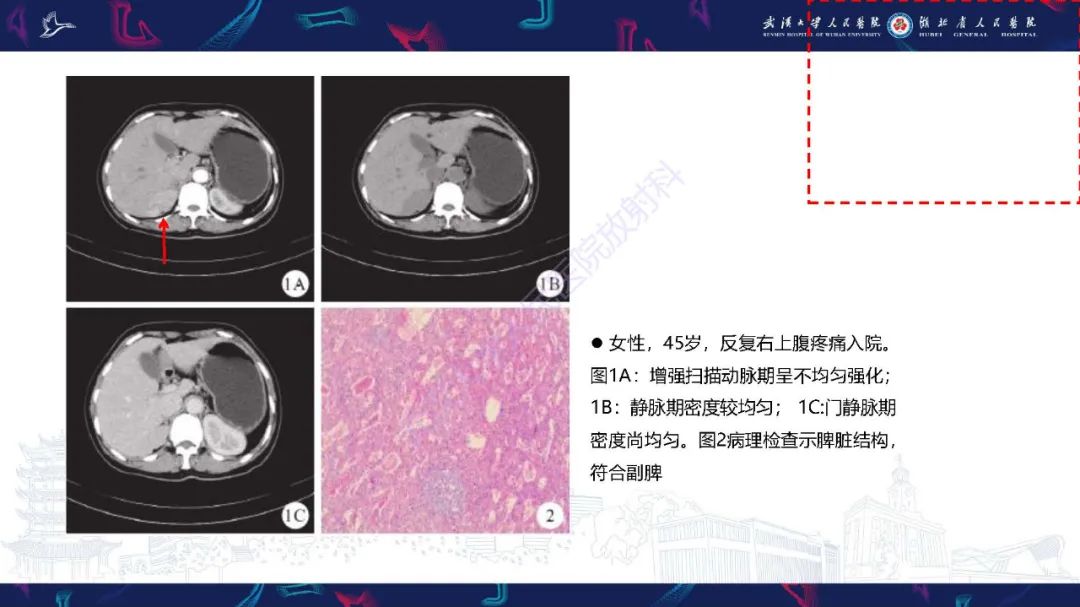 影像PPT - 【PPT】先天性脾脏异常影像诊断-20