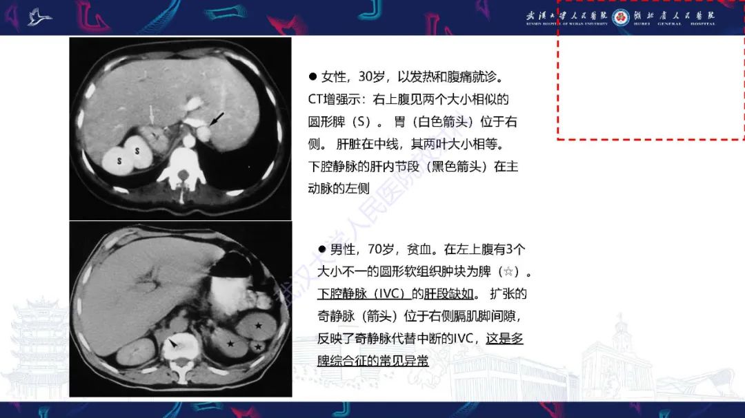 影像PPT - 【PPT】先天性脾脏异常影像诊断-22