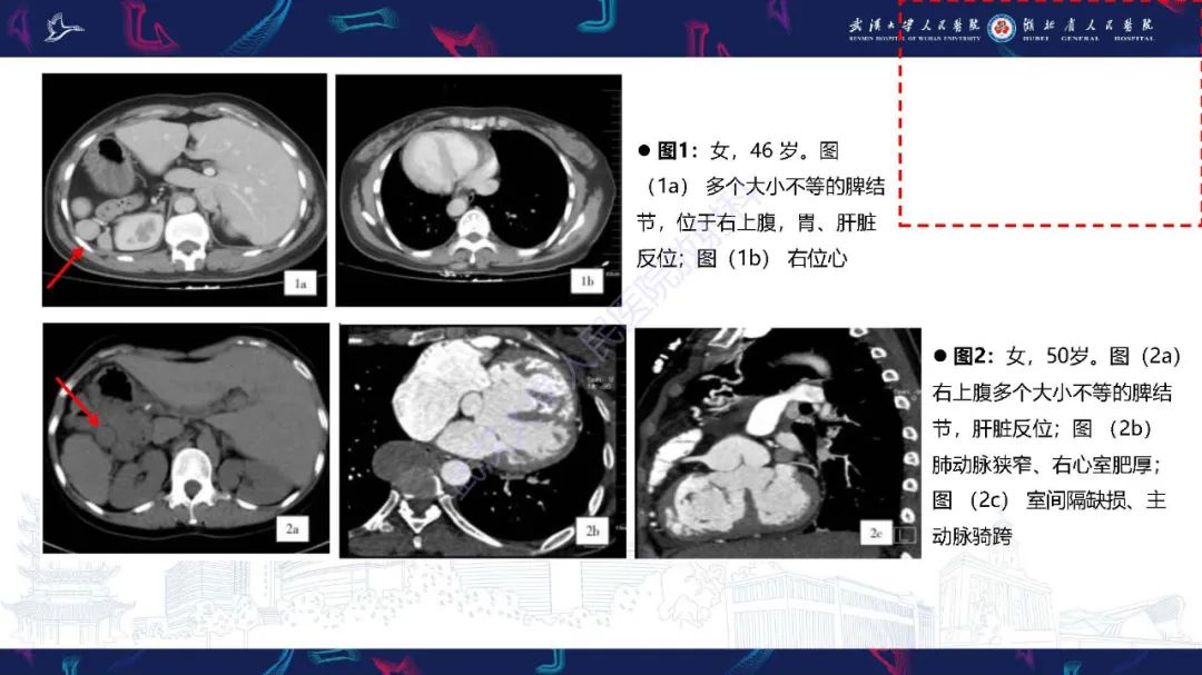 影像PPT - 【PPT】先天性脾脏异常影像诊断-23