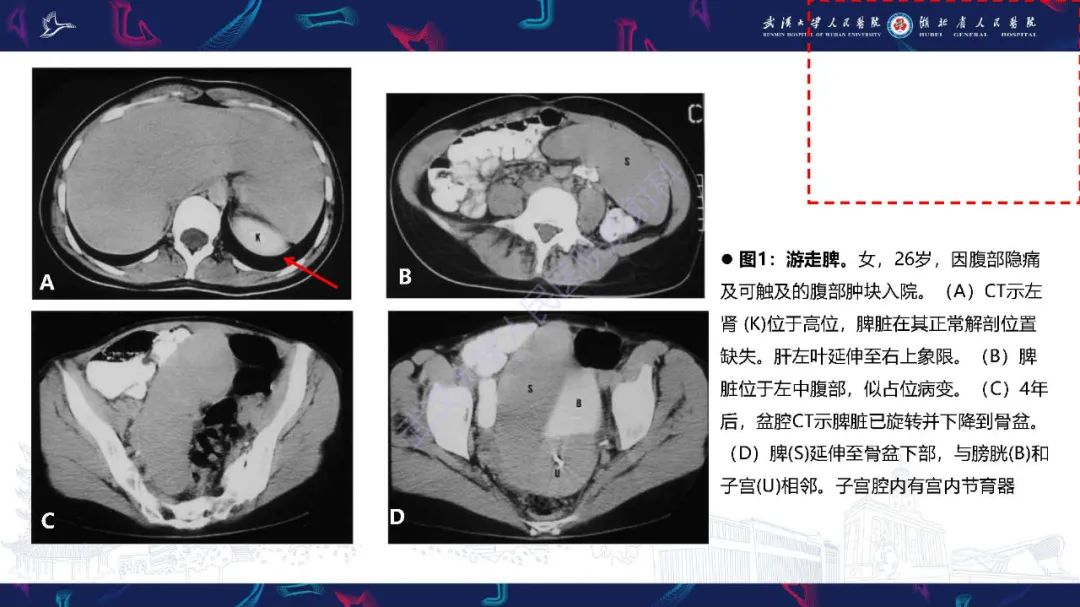 影像PPT - 【PPT】先天性脾脏异常影像诊断-27