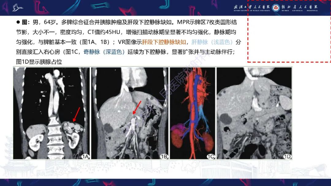 影像PPT - 【PPT】先天性脾脏异常影像诊断-24