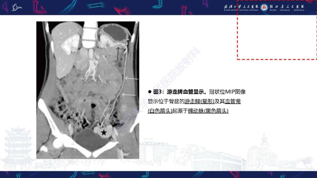 影像PPT - 【PPT】先天性脾脏异常影像诊断-29