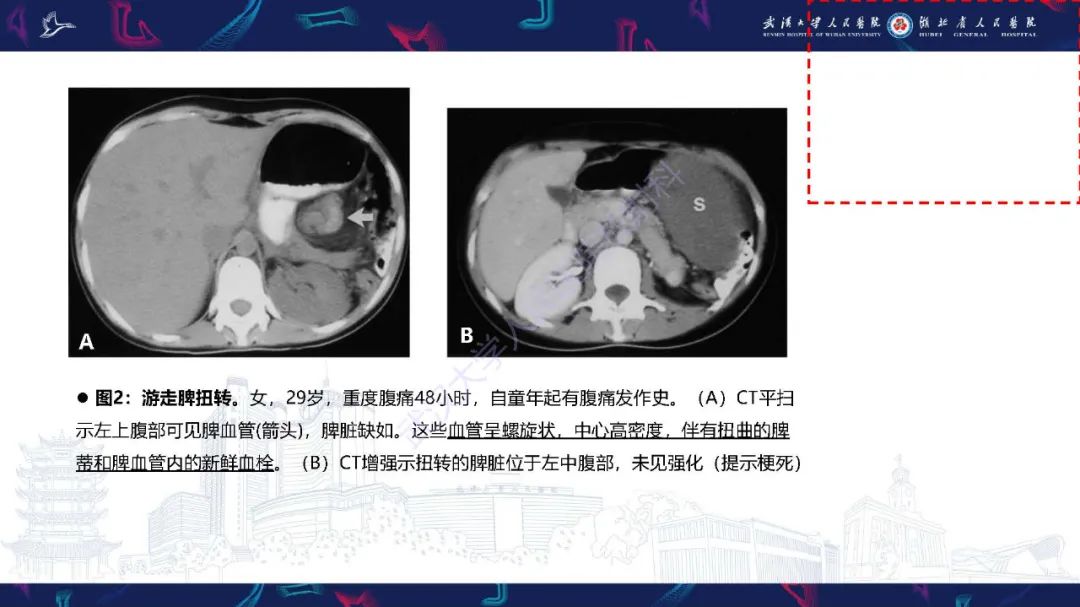 影像PPT - 【PPT】先天性脾脏异常影像诊断-28