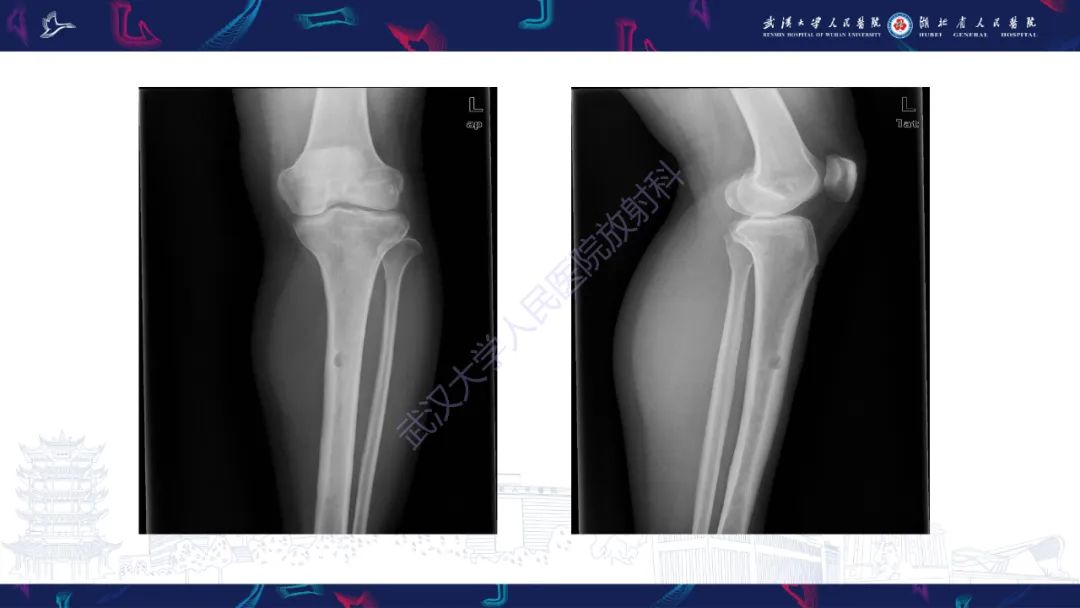影像PPT - 【PPT】Rosai-Dorfman病影像诊断-3