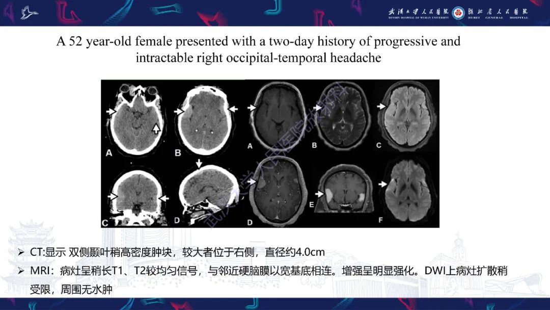 影像PPT - 【PPT】Rosai-Dorfman病影像诊断-16