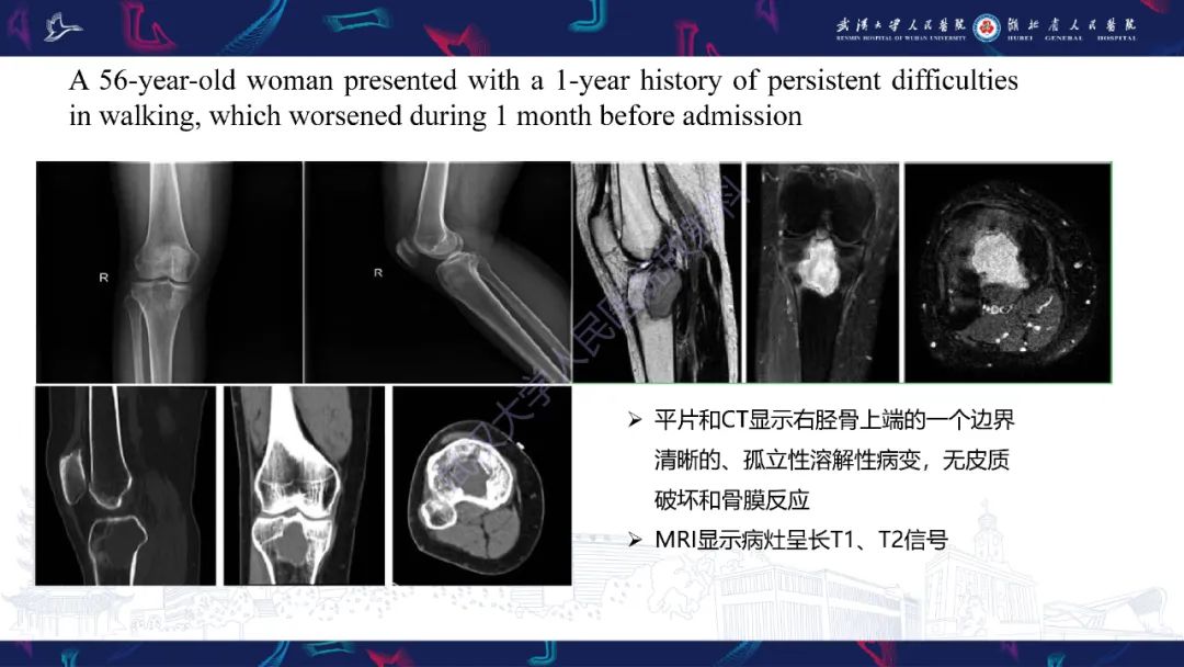 影像PPT - 【PPT】Rosai-Dorfman病影像诊断-15