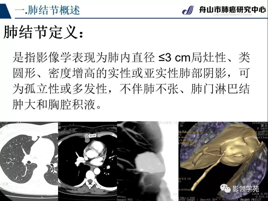 影像PPT - 【PPT】肺良恶性结节CT征象及鉴别诊断-3