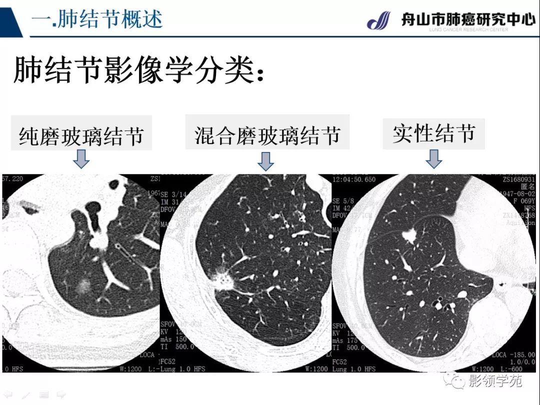 影像PPT - 【PPT】肺良恶性结节CT征象及鉴别诊断-5
