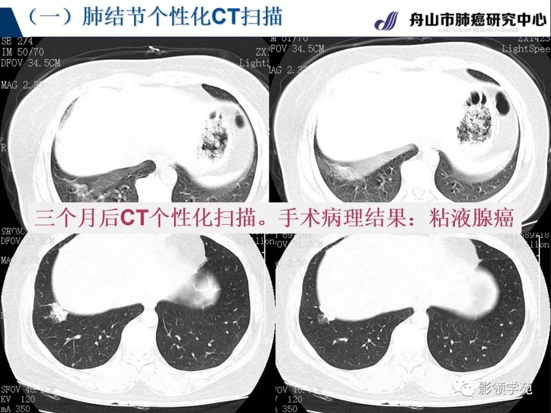 影像PPT - 【PPT】肺良恶性结节CT征象及鉴别诊断-12