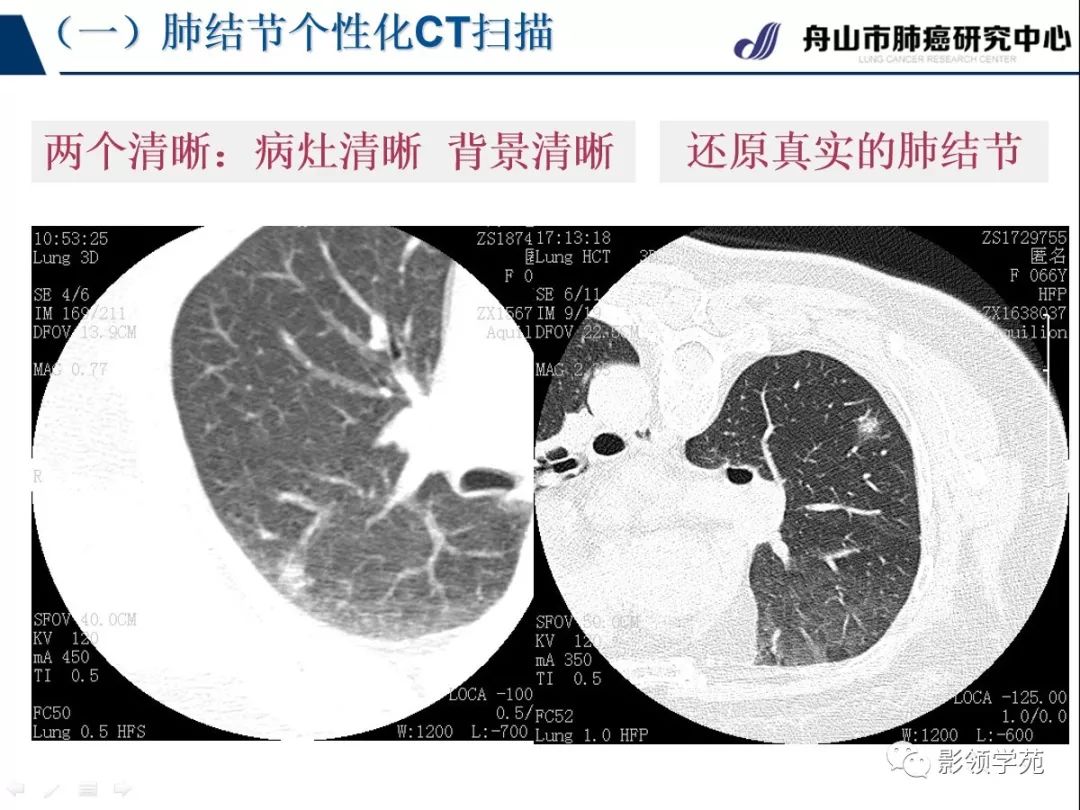 影像PPT - 【PPT】肺良恶性结节CT征象及鉴别诊断-11