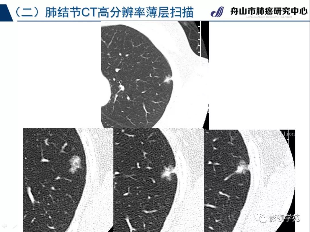 影像PPT - 【PPT】肺良恶性结节CT征象及鉴别诊断-13