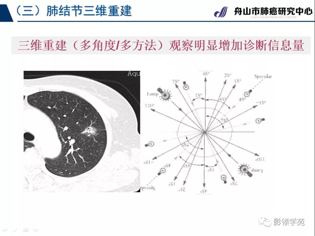 影像PPT - 【PPT】肺良恶性结节CT征象及鉴别诊断-14