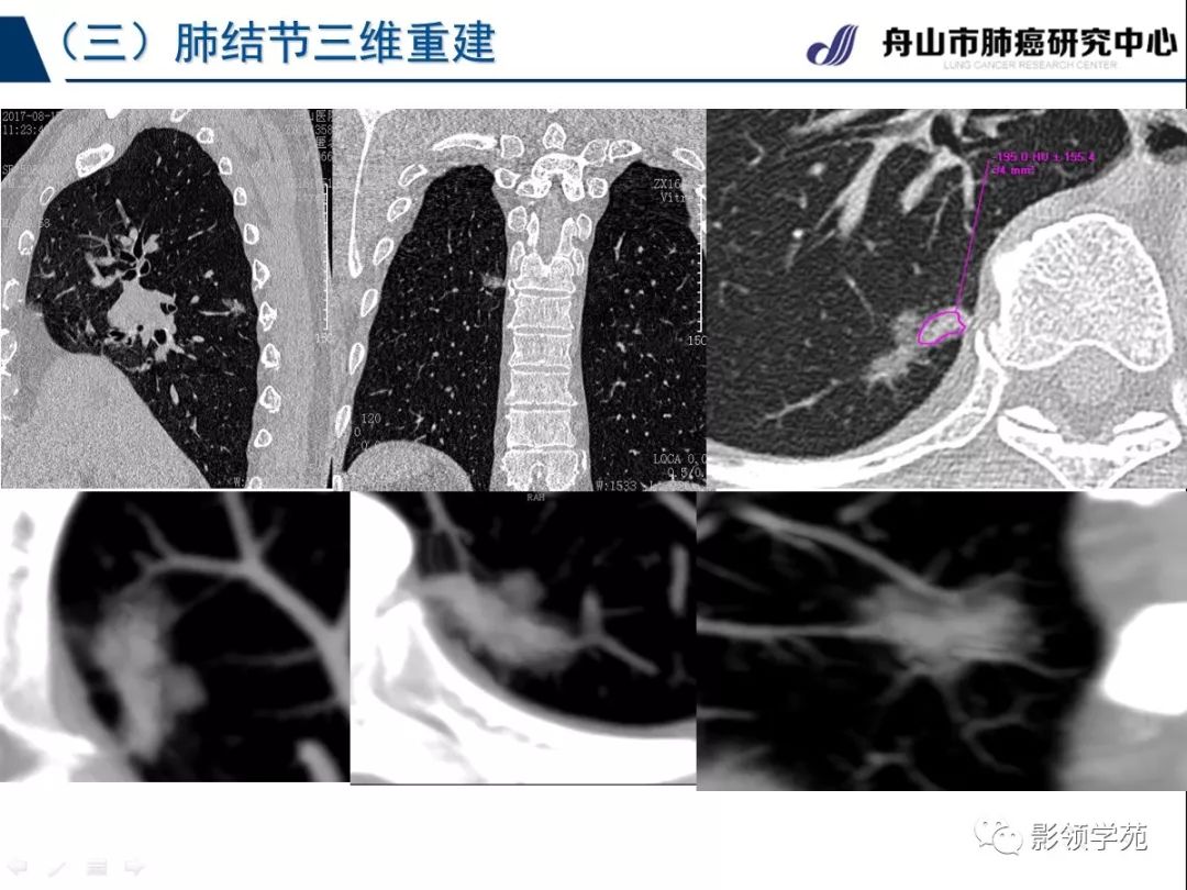 影像PPT - 【PPT】肺良恶性结节CT征象及鉴别诊断-17