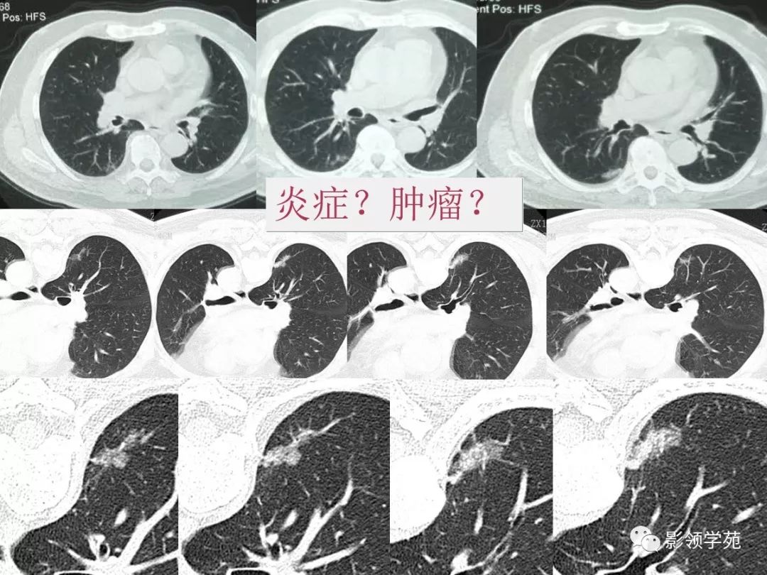 影像PPT - 【PPT】肺良恶性结节CT征象及鉴别诊断-16