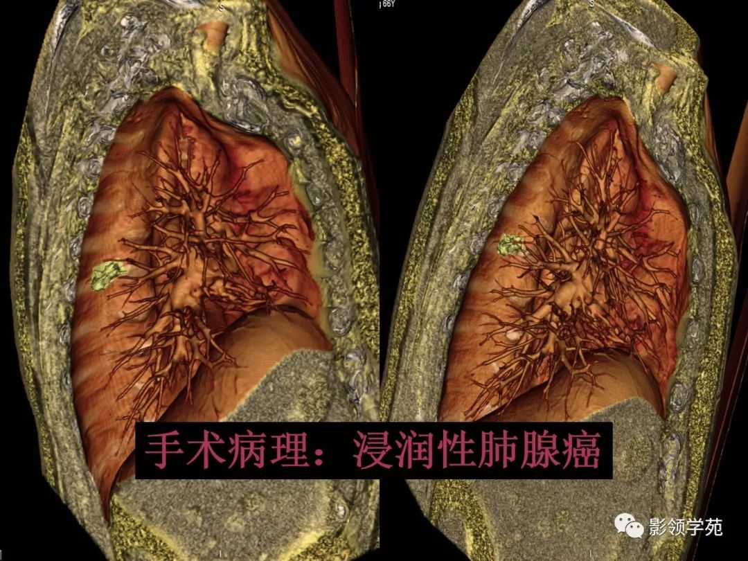 影像PPT - 【PPT】肺良恶性结节CT征象及鉴别诊断-20